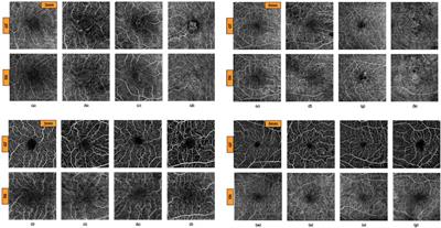 Quantitative characterization of retinal features in translated OCTA